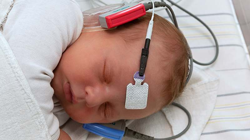 Infant receiving newborn hearing screening with sensor electrodes to support early diagnosis of hearing loss.