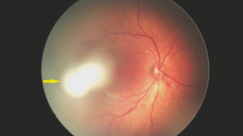 Retinal image of a newborn showing signs of congenital eye disease, emphasizing early detection and diagnosis of pediatric retinal conditions.