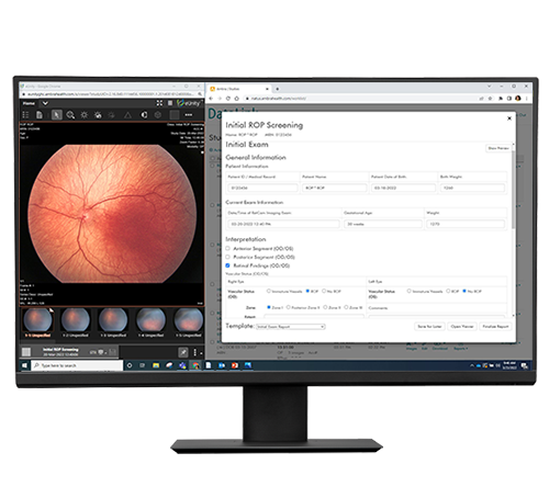 Monitor displaying retinal image and electronic medical record interface using Datalink for RetCam Envision, facilitating integrated eye screening documentation.