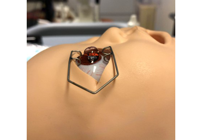 Simulation model of an infant eye with lid speculum in place, used for training clinicians in the ROP screening process and early retinal examination techniques.