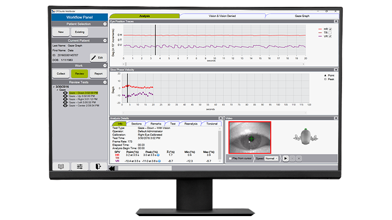 Analysis software interface displaying eye tracking data and graphs for vestibular assessment using ICS Impulse.