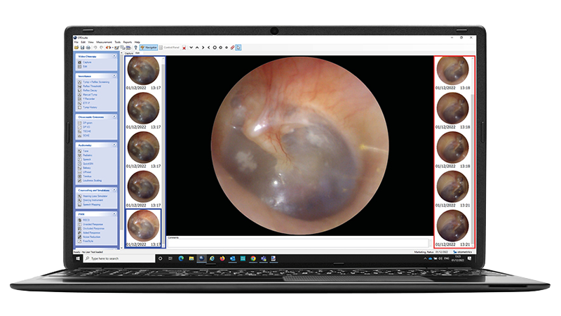 High-resolution ear image displayed on laptop using Aurical Otocam 300 video otoscope software.