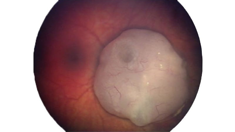 Retinal image showing signs of retinoblastoma in an infant, used in pediatric retinal imaging for diagnosis of early-onset eye diseases in newborns.