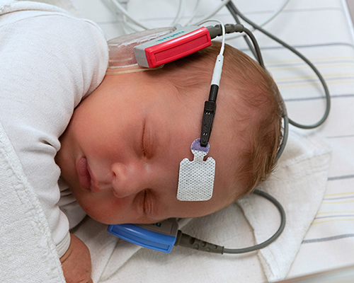 Newborn undergoing hearing screening with electrode sensors during early detection of infant hearing loss.